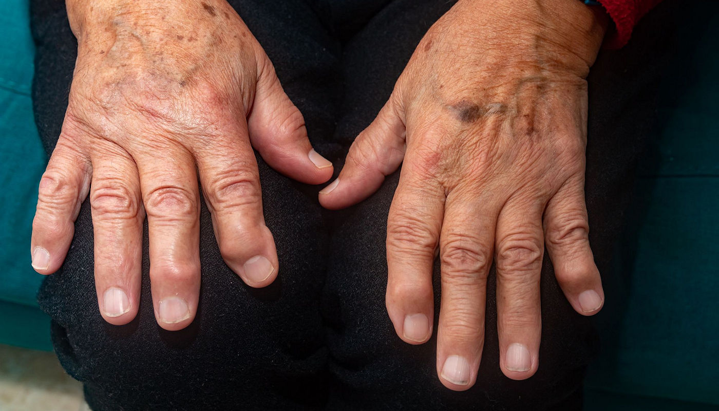 26 Faits Sur Arthrose