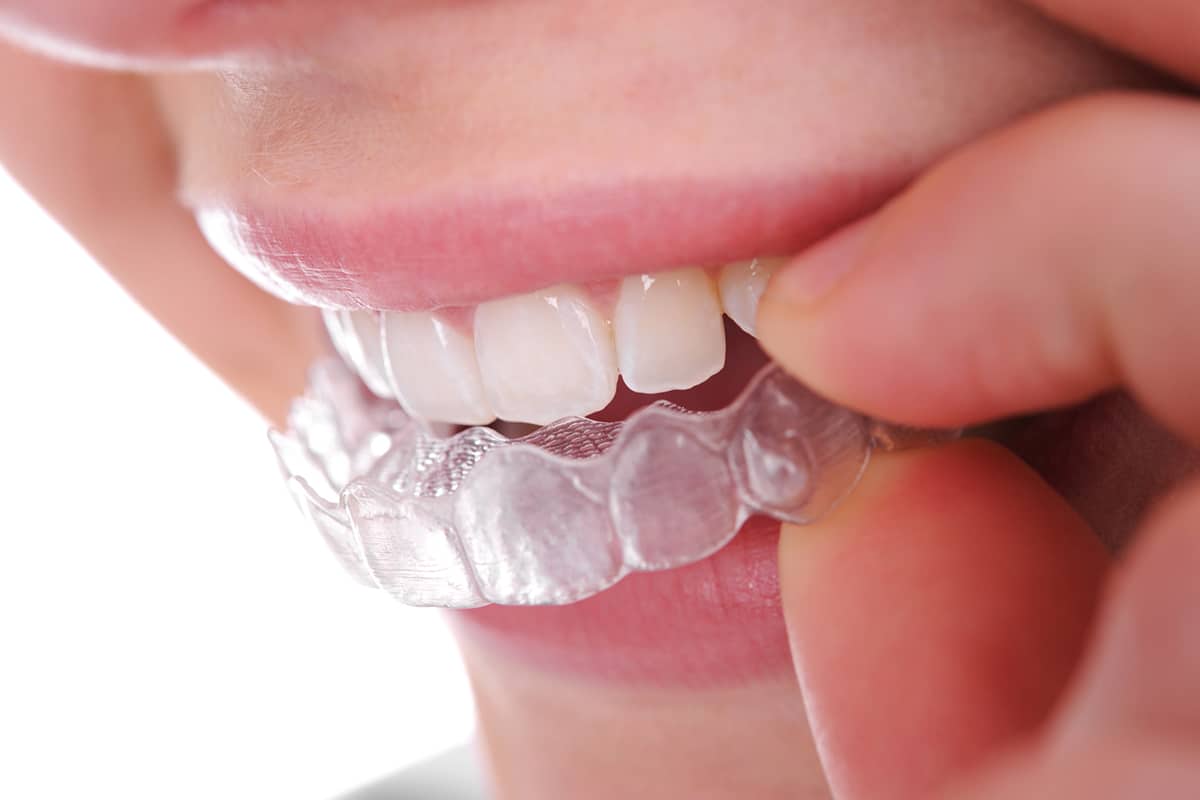 29 Faits Sur Invisalign