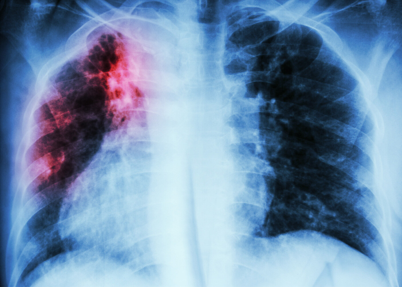 29 Faits Sur Tuberculose
