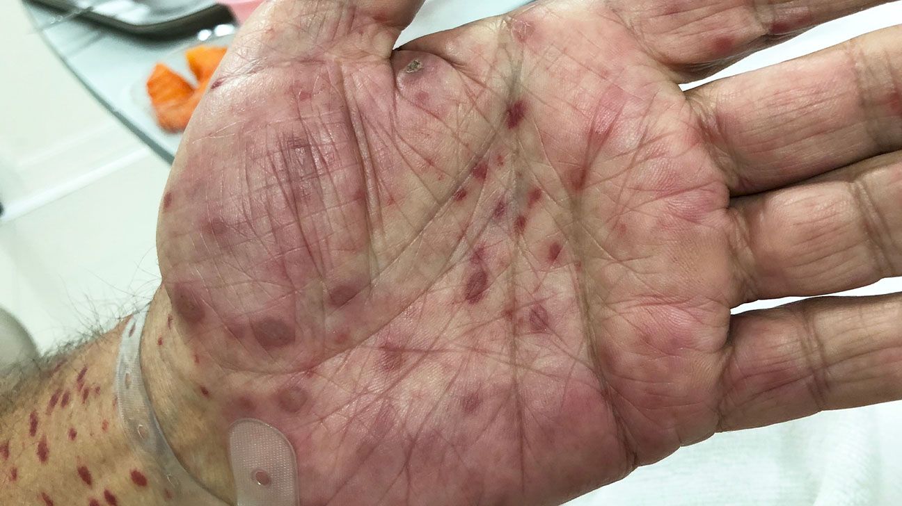 30 Faits Sur Syphilis