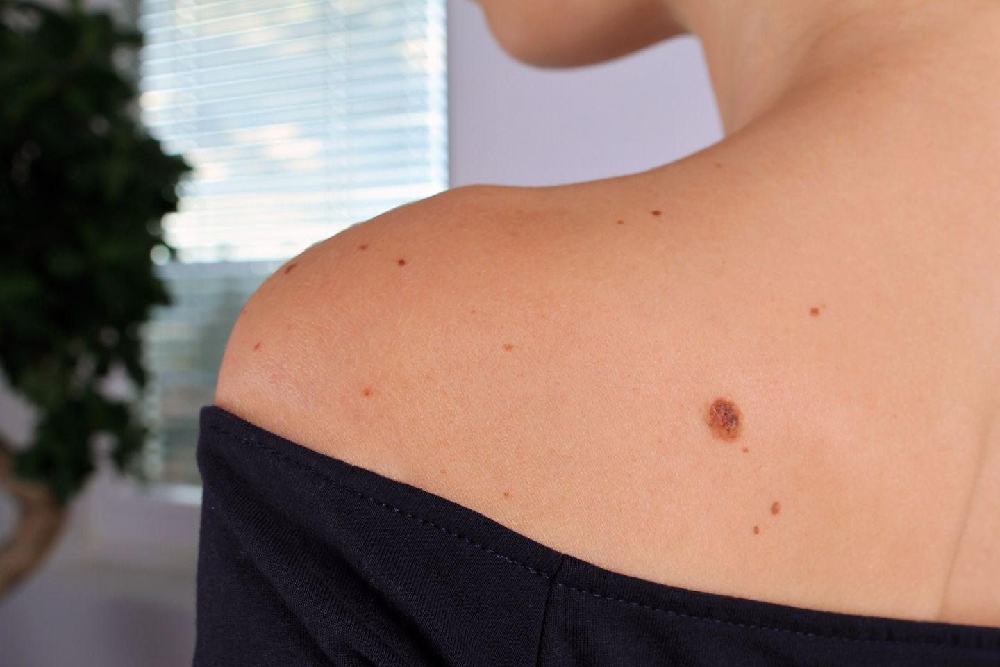 36 Faits Sur Grains De Beauté