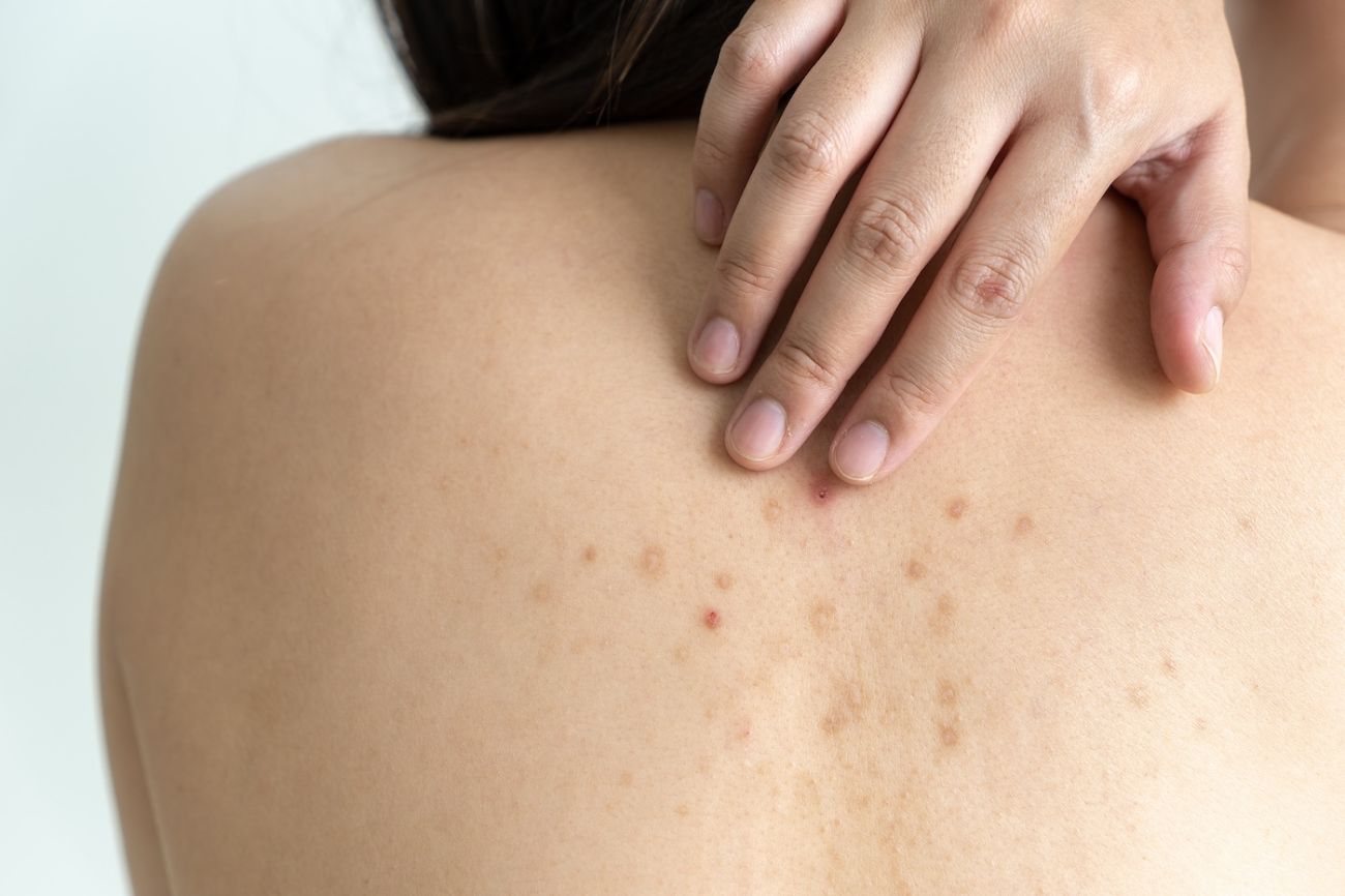 39 Faits Sur Mélanome