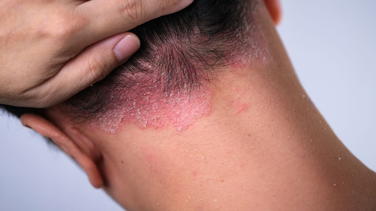 40 Faits Sur Psoriasis